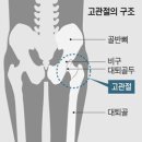 뼈가 썩는 병 술이 고관절까지 망칩니다 이미지