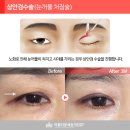 아름다운세상피부과 Daum카페