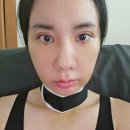 이중턱지방흡입비용 찾아본 뒤 투턱 제거한 후기!