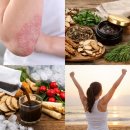 386친구들 | 피부건선치료 성공한 유성구건선 친구 치료4개월 후기