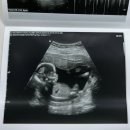 메디렌느산부인과의원 | 16주차 : 중랑 메디렌느 산부인과 성별 확인 +) 씨에라 여성의원