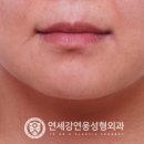 청주성형외과 가경동 근처 실리프팅 알아보고있다면
