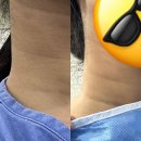 피엘의원 | 안산뮤즈의원 목주름/리쥬비엘 2cc/목주름 필러 한 달 차 후기/목주름필러 장점/단점/부작용