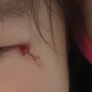 [수원 미세성형외과] 아기 눈가 찢어짐 사고, 응급실 대신 선택한 유아 봉합 후기