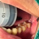 클린연세치주과치과의원 | [아산 연세원치과]지독한 입 냄새, 양치질 문제가 아니라 '썩고 있는 사랑니' 때문입니다