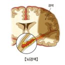 [치매] 뇌졸증(중풍) 이란 혈관이 막히거나(뇌경색), 터짐(뇌출혈) 이미지