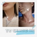 목은빌딩 | 강남역 편평사마귀제거 경험 거우침으로 깔끔하게 케어한 후기