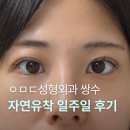 수원강남약국 | 압구정 아몬드성형외과 내돈내산 자연유착 일주일 후기 (붓기/출근/겹주름)