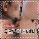 드림필 | 울산 성인남자여드름관리 3회차 유드림에스테틱 스피큘 레디언트 필 피부관리