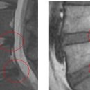 Radiance님의 군대 신검관련 허리디스크 mri 판독입니다. [4급 판정] 이미지