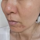 인터코어 | 강남색소치료 코어레이저 색소와 모공 관리로 맑아진 피부 톤 후기