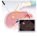 간암의 고주파 열치료술(Radiofrequency Ablation, RFA)이란 무엇인가? 이미지