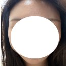 아젤리아헤어 | [모낭염 치료기 2탄] 아젤리아 크림 3주 사용 : 많이 나아진 후기