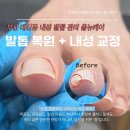 올뉴케어 | 부산 서대신동 내성발톱 교정 발톱 복원 아크릴 관리 올뉴케어 후기