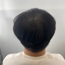 구미 정수리 탈모커버 잘하는 곳 더블라인스칼프 남성 후기 탈모관리 시작