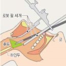 합병증없는 하인두암 로봇 수술 도입 이미지