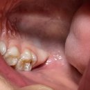 웃음치료의 힘 | 5세 유치 어금니 충치 치료 🦷 소아치과 웃음가스 치료 성공 후기
