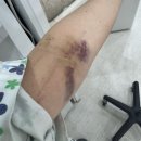 의료법인 청해의료재단 제일병원 | 대구 구병원 담낭 제거 복강경 수술 후기 (입원기간, 수술비용)