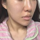 지우의원 | 안 아픈 무통리쥬란, NP스킨부스터 후기