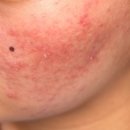 선일초등학교 | 은평구피부과 여드름치료, 화농성 없애는데 1년도 안걸린 후기!