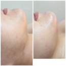 미랑뷰티(mirang Beauty) | 병점피부관리 미랑에서 리프팅 윤곽후기 - DPL 웨딩관리