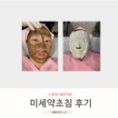태인한의원 | 노원여드름 치료 레이저대신 미세약초침 받은 후기