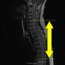 척수염[myelitis] 이미지