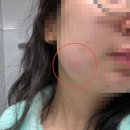 사랑치과의원 | 창원 사랑니사랑치과 : 사랑니 발치 후기