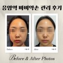 기분좋은 약손 한약국 | 은평 응암역 림프부종 스톤 마사지 바비약손 내돈내산 후기(비포애프터 사진)