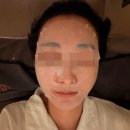 써니 | 중랑구피부과 써니리프팅 잘하는곳 추천 후기