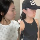 리즈멍 | 강남피부과 리즈톡신 턱보톡스 50유닛 솔직 후기 효과 멍 붓기 통증