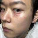 아가파의원 - 중구 흰바위로 31 | [아가파 의원 계양점] 가성비 비립종 편평사마귀 제거 후기 리얼 후기 내돈내산 !!!!(눈밑 제거 진짜...