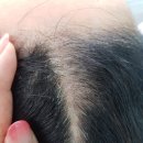 양산두피커버 디블랙 아카데미에서 컴플렉스를 덜 수 있어요