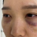 배치 | 눈밑지방재배치 후기 체크사항 알려드림