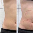 대구복부관리 성당동 클로이스킨에서 셀핏 바디 1회 관리로 뱃살이 날렵해진 후기