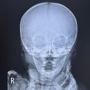 동수로52번길 | 인천성모병원 어린이재활의학과 사두 엑스레이 찍고온 후기 (+두상헬멧 적응기)