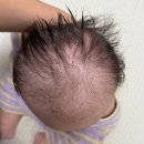 성모가정의학과 | 단두증 헬멧 후기 단두증 교정 지오헬멧