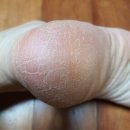 (주)웰스팜텍 | 굳은살과 각질 제거 더마겐 우레아크림