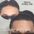 부산 헤어라인 교정 2회 차 완성 이미지