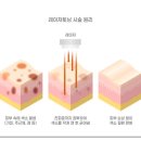 유앤아이디스커버리 | 레이저토닝 피코토닝 차이는? [디스커버리 피코]