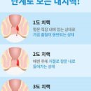 치질 탈모 무좀 초기 증상 및 빠른 치료 방법과 예방법 알아보기 이미지