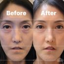 텐션 | 메디테라피 텐션업 마스크 한 달 후기 50대 피부탄력 &amp; 주름변화