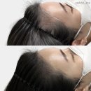 선헤어라인 이미지