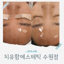 망포 래미안 앞 | 수원 영통피부관리 치유함에스테틱에서 아크네 밸런스 관리받은 후기