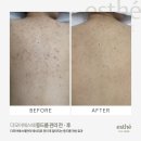 바디모어핏 | 부산연산동등드름관리 웨딩관리 청소년등드름 바디트러블 엉드름,가드름 패인흉터제거 잘하는곳 피부...