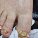 지산역 | 대구 수성구 지산역 발톱무좀 안아프게 해결해주는 곳 네일바이엘