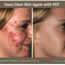 덕천리전*균태양광 | 여드름 재발 때문에 PDT 또 받았습니다…어떡하죠?? 중독되면...