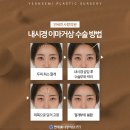 연세헤어성형외과의원 네이버블로그