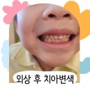 서부라온치과병원 | 외상 후 유아 치아 변색 대처법, 전주 소아치과 방문후기