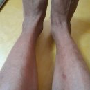 다은메드 | 건선정복/피부 가려움증 후기를 소개해요